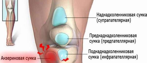 Анзериновый бурсит сустава колена